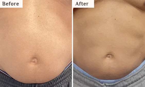 PCDC injections before after